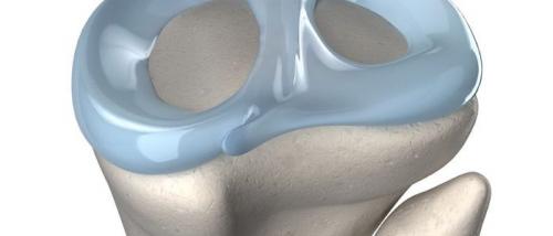 Лечение мениска без операции. Как лечить мениск в домашних условиях?