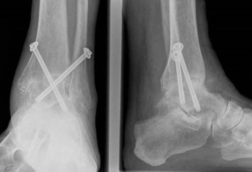 Артродез голеностопного сустава стержнем. Что за операция артродез голеностопного сустава?