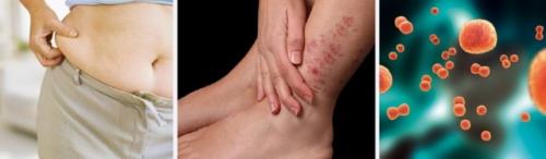 Мкб 10 артрит голеностопного сустава. Артрозо-артрит голеностопного сустава: код мкб-10, симптомы и лечение