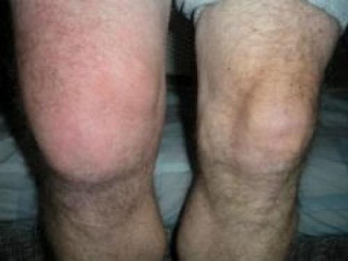 Колено покраснело и горячее. Почему горят и краснеют колени 03 Колено покраснело и горячее. Почему горят и краснеют колени 03