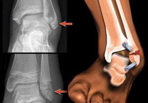 Артродез голеностопного сустава аппаратом илизарова. Способы выполнения артродеза