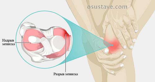 Повреждения заднего рога медиального мениска 2 степени по stoller лечение. Виды повреждений мениска коленного сустава: их обзор, степени, симптомы и лечение