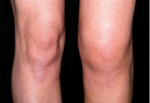 Мениск 3 степени коленного сустава. Клинические проявления