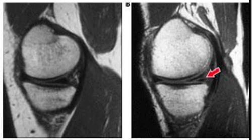 Stoller 2 степени повреждения мениска. Повреждение мениска 2 степени