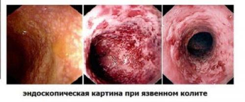 Температура боль в животе. Какие заболевания сопровождаются болью в животе, поносом и температурой