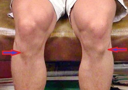 Колено покраснело и опухло, что это. Причины