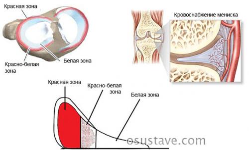 Повреждён мениск коленного сустава, что делать. Что такое мениск коленного сустава, возможные повреждения, их причины и лечение