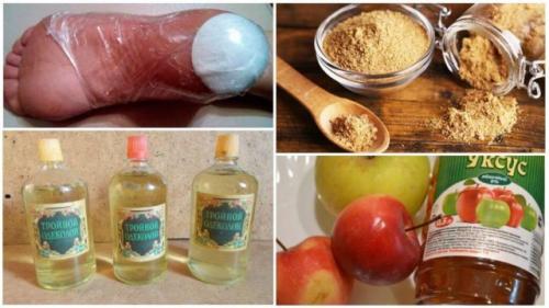 Пяточная шпора лечение народными средствами йодом. Йод при пяточной шпоре: рецепты комбинированных средств