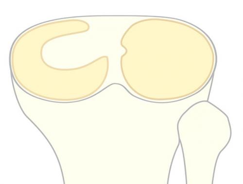 Повреждён мениск коленного сустава, что делать. Что такое мениск коленного сустава, возможные повреждения, их причины и лечение