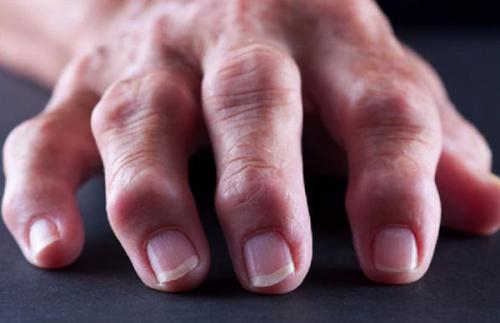 Шишка на сгибе пальца руки. Какие виды встречаются