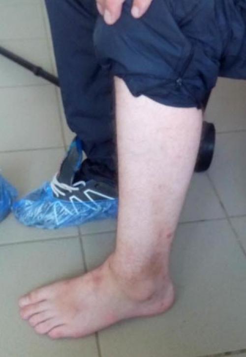 Подвывих нижней конечности. 1 Что происходит с лодыжкой при подвывихе, и в чем отличие от вывиха?