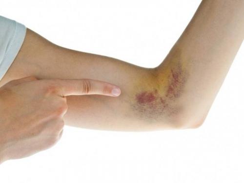 Чем опасен разрыв средней оболочечной артерии. Повреждение сосудов — виды, опасности, первая помощь