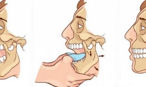 Подвывих нижней челюсти, как вправить. Вывих челюсти: симптомы и лечение