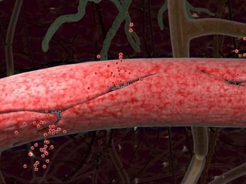 Чем опасен разрыв средней оболочечной артерии. Повреждение сосудов — виды, опасности, первая помощь