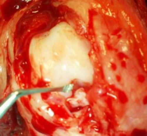 Тазобедренный сустав Фото рентгена здорового и больного человека с описанием. Строение и патологии +Видео