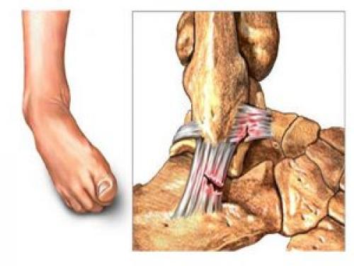 Узи голеностопного сустава. Ультразвуковое исследование голеностопного сустава