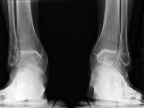 Голеностопного сустава разработка. Что делать после травмы 07