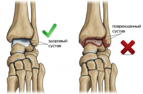 Голеностопного сустава разработка. Что делать после травмы 08