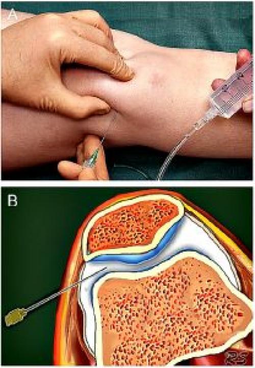 Уколы в коленный сустав при артрозе препараты. Уколы в колено при артрозе