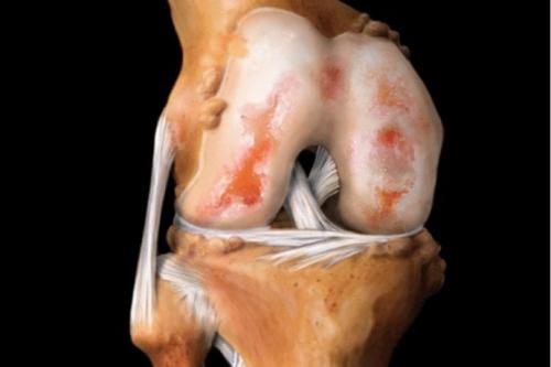 Лекарство для восстановления хрящевой ткани коленного сустава. Препараты для восстановления хрящевой ткани суставов: мифы и реальность