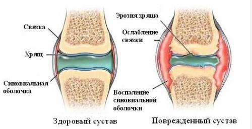 Хондропротекторы. Препараты-хондропротекторы для суставов
