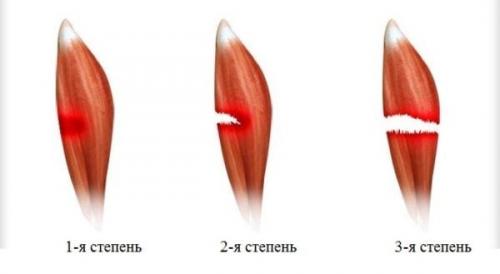Разрыв икроножной мышцы, что делать. Растяжение икроножной мышцы: симптомы и лечение боли