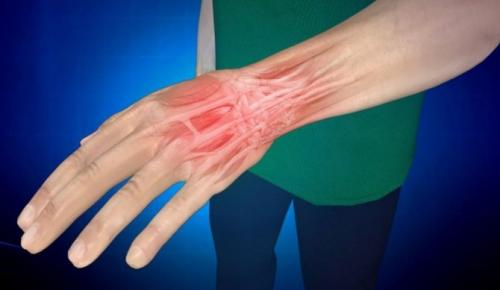 Повязка при растяжении запястья. Признаки растяжения запястья