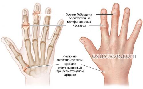 На фалангах пальцев наросты. Шишки на суставах пальцев рук: причины, диагностика и лечение