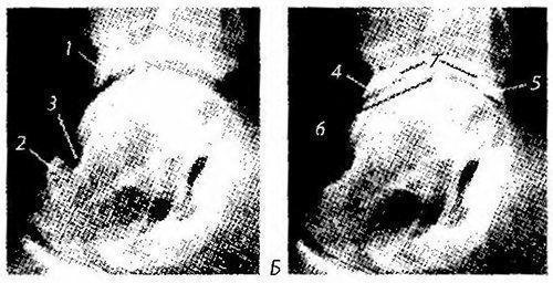 Блок таранной кости. Виды травм таранной кости 04