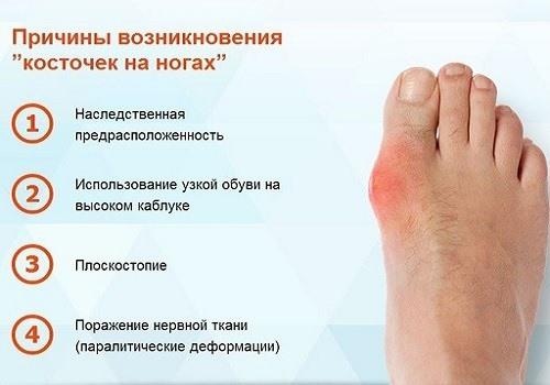Почему растет косточка на ноге возле большого пальца у мужчин. Почему растет косточка на ноге?