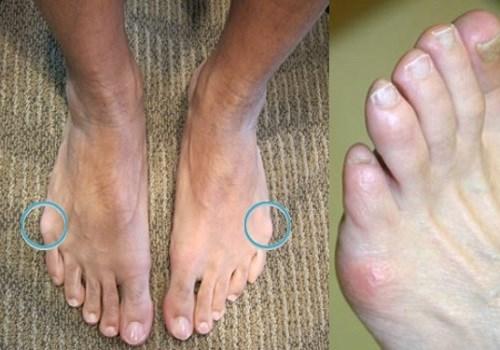 Почему растет косточка на ноге у мизинца. Причины возникновения шишки возле мизинца