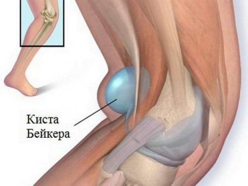 Киста Бехтерева в коленном суставе чем обезболить. Традиционная терапия