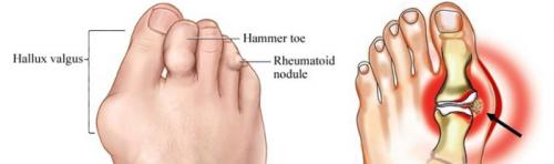 Шишка на указательном пальце ноги сверху лечение дома. Причины возникновения косточки на пальце ноги сверху и методы лечения