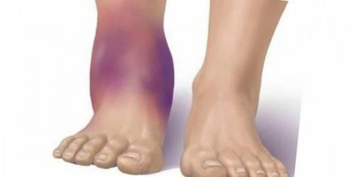 Синовит голеностопного сустава код по мк.  Причины патологии: виды синовита