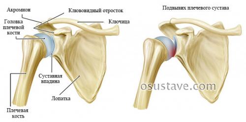 Как определить вывих плеча или растяжение. Причины, симптомы и лечение вывиха плечевого сустава