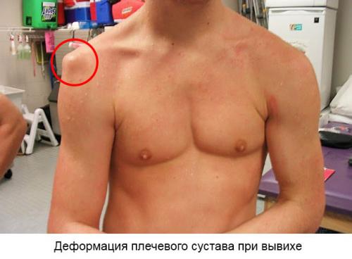 Как определить вывих плеча или растяжение. Причины, симптомы и лечение вывиха плечевого сустава