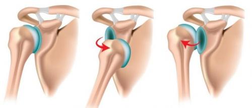 Подвывих плеча. Подвывих сустава плеча