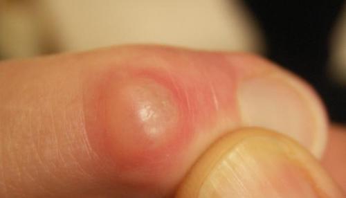 Отложение солей на пальцах рук. Симптомы