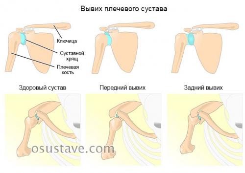 Как определить вывих плеча или растяжение. Причины, симптомы и лечение вывиха плечевого сустава