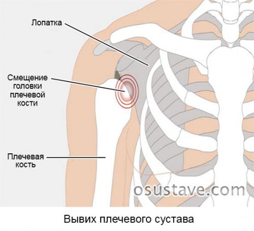 Как определить вывих плеча или растяжение. Причины, симптомы и лечение вывиха плечевого сустава