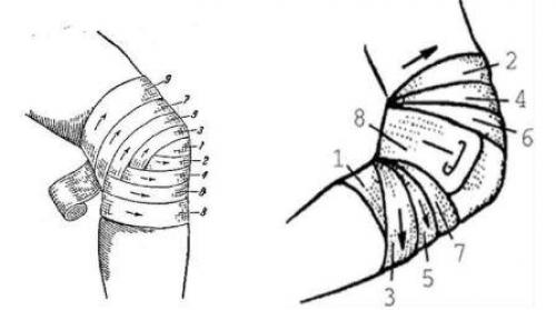 Колосовидная повязка на бедро. Как наложить повязку на травмированную ногу