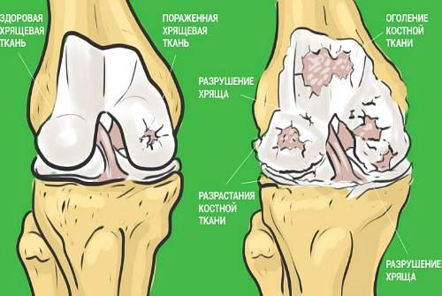 Как в лечебных целях принимать желатин. Желатин для суставов: миф или реальная помощь при травмах в спорте?