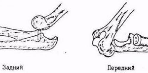 Вывих локтевого сустава. Вывих сустава локтя