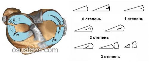 Мениск коленного сустава. Виды повреждений мениска коленного сустава: их обзор, степени, симптомы и лечение