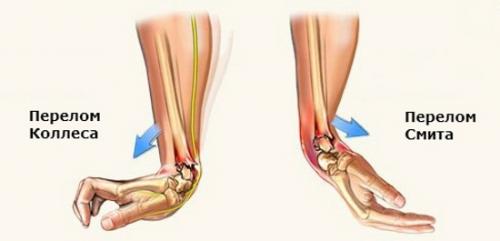 Перелом головки лучевой кости мкб. Классификация травмы