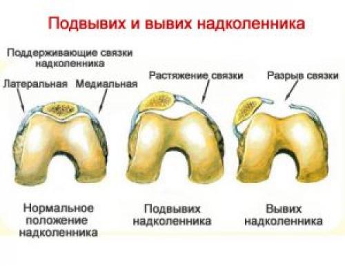 Как вправить мениск самостоятельно. Как вправить колено?