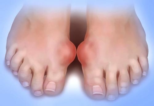 Гнойный артрит голеностопного сустава код по мкб. Артрит голеностопного сустава: что это?