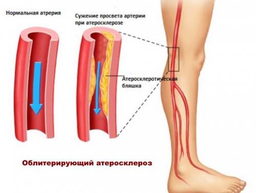 Судороги мышц бедра причины и лечение. Cудороги мышц ног и бедра ночью и днем: причины и лечение +Фото