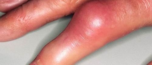 Болит и опух сустав указательного пальца. Опухают суставы на пальцах рук