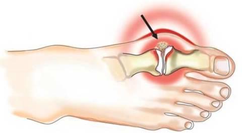 Пальцы ног болезни. Какие бывают болезни пальцев ног?